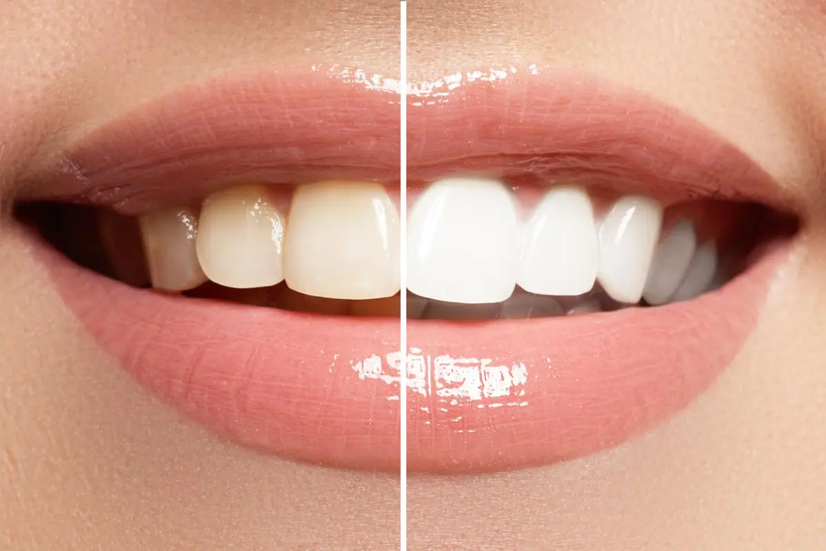 Post Dental Whitening: Essential Tips for Optimal Results