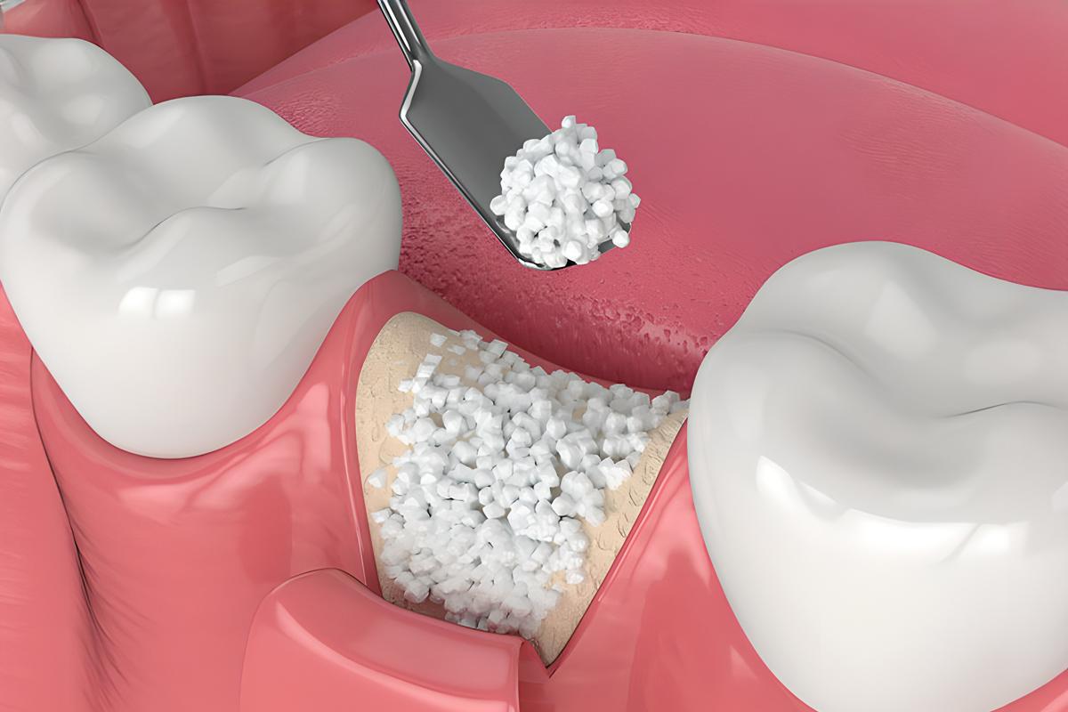 Bone Grafting & Sinus Lifting