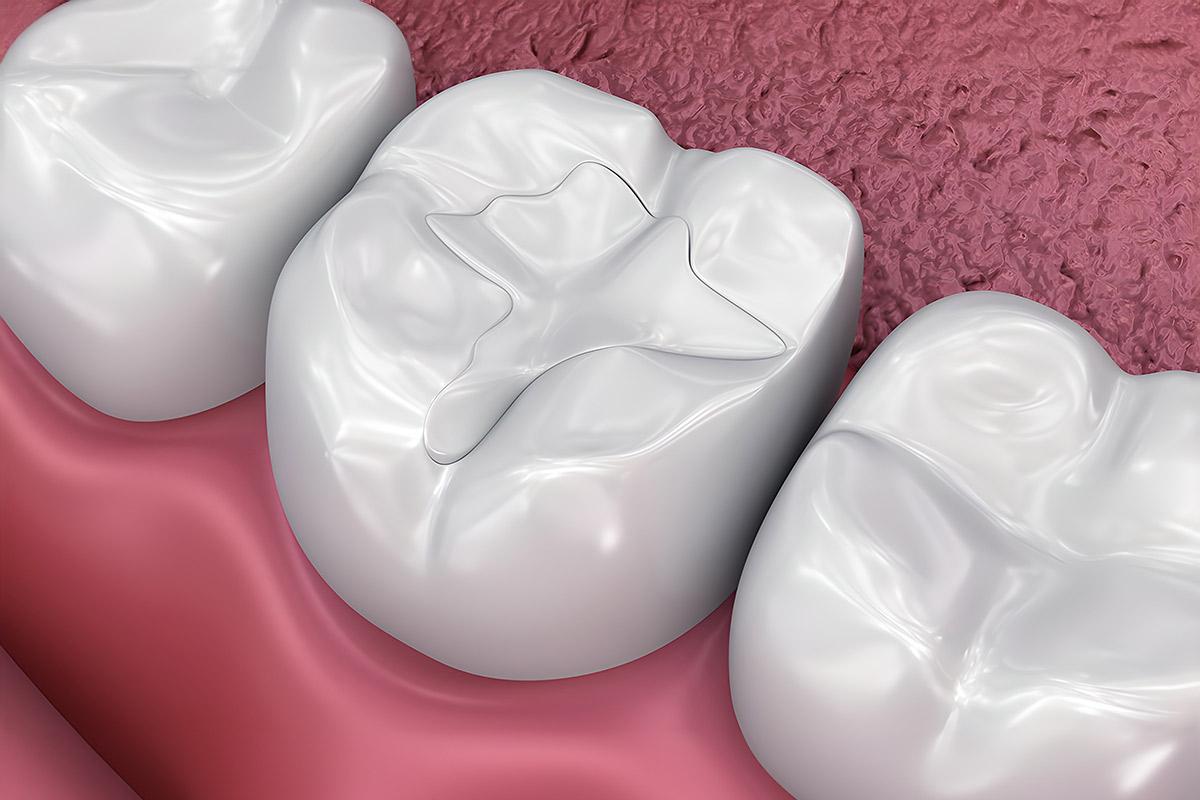 Procedimientos de Empaste Dental