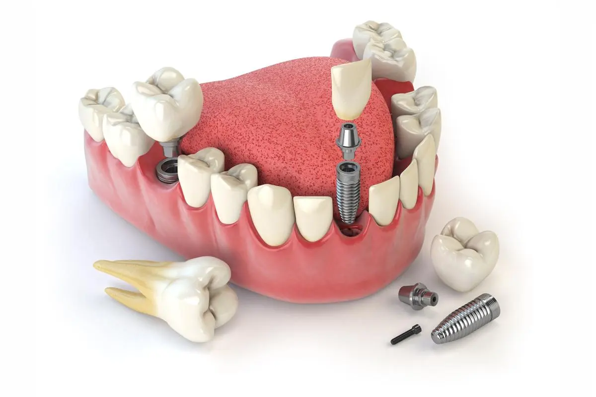 Dental Implant Treatment