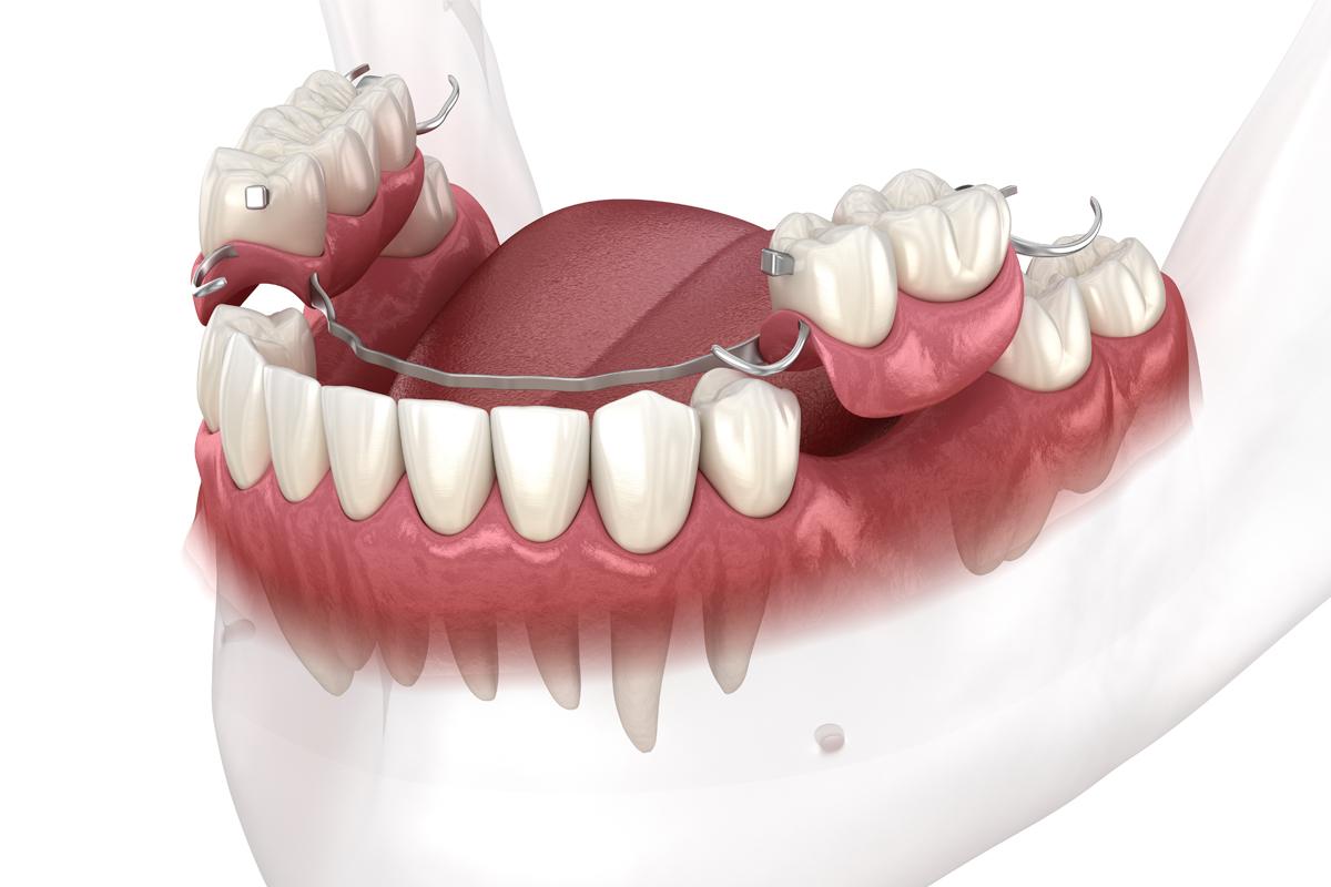 Prótesis Dentales