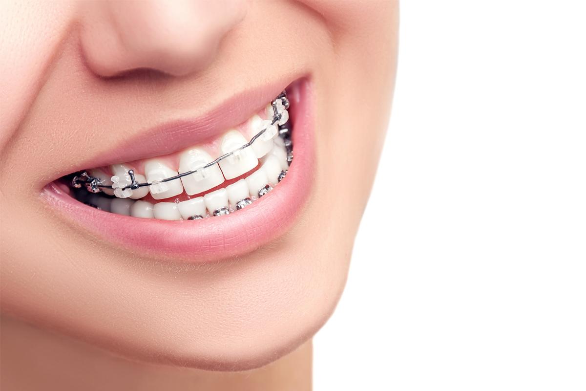 Orthodontic Treatments