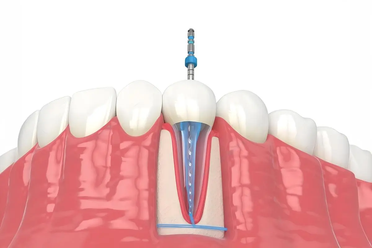 Root Canal Treatment