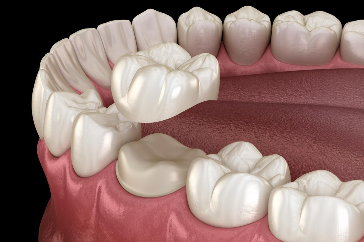 Zirconium Crowns